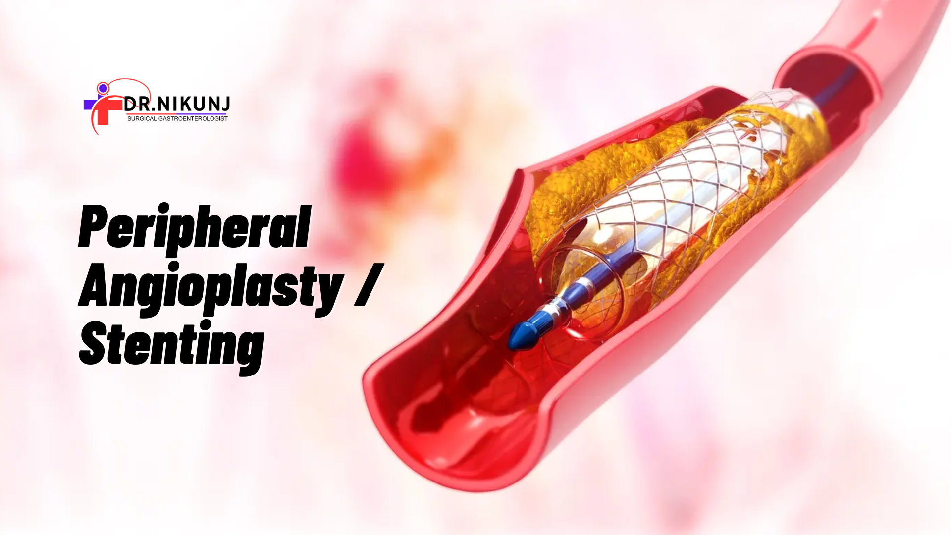 Peripheral Angioplasty And Stenting A Comprehensive Guide