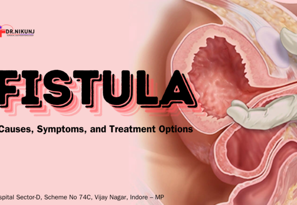 Fistula: Causes, Symptoms, and Treatment Options