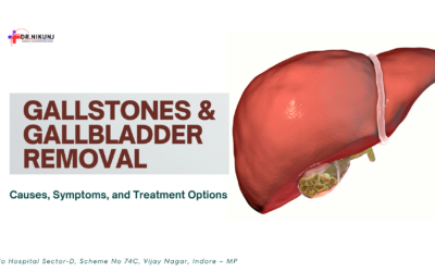 Gallstones and Gallbladder Removal: Causes, Symptoms, and Treatment Options