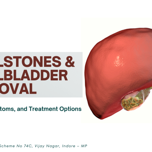 Gallstones and Gallbladder Removal: Causes, Symptoms, and Treatment Options