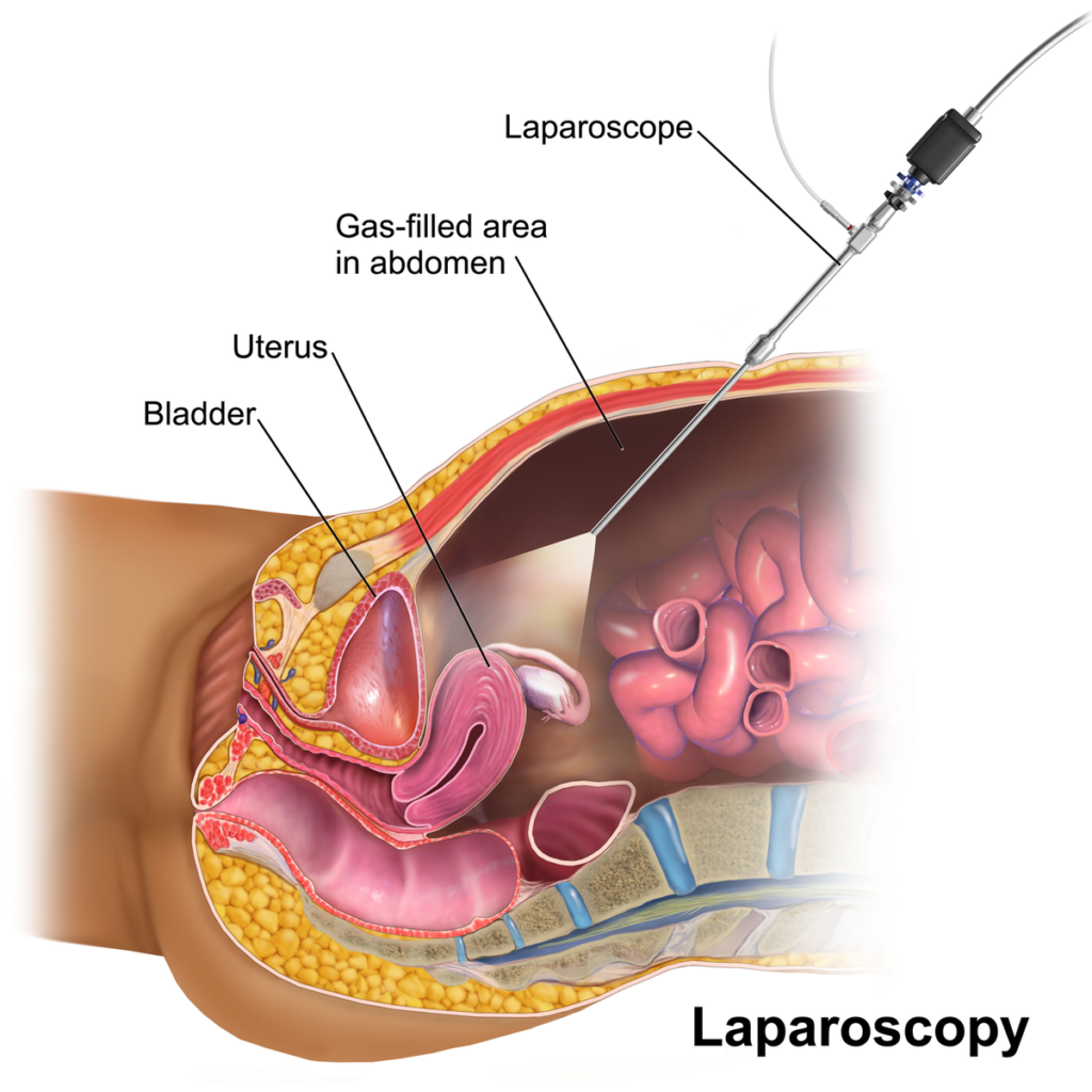 Laparoscopic Surgery Indore