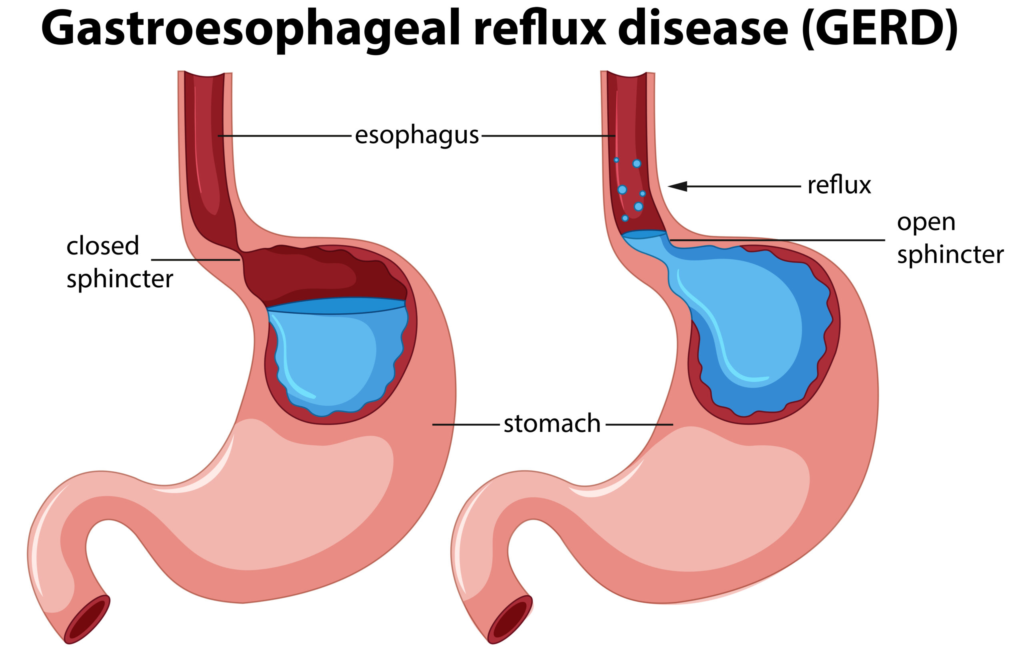 Reflux Problems Treatment