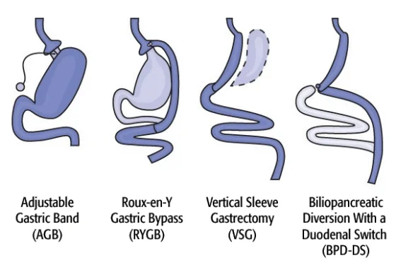 Choosing the Best Bariatric Surgeon in Indore