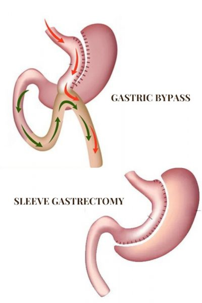 Bariatric Surgeon in Indore