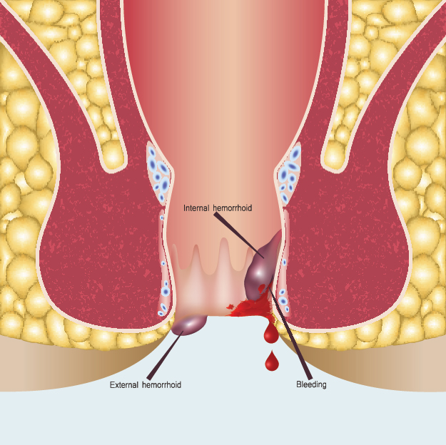 Laser Piles Treatment in Indore
