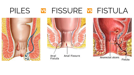 A doctor in Indore specializing in fissure, fistula, and hemorrhoid treatments.