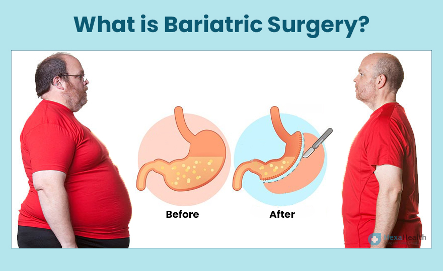 Bariatric Surgery in Indore