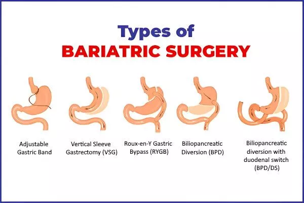 Types of Bariatric Surgery
