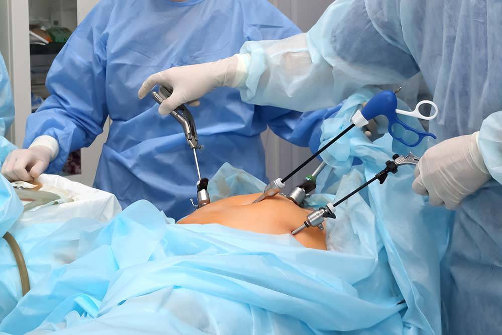 Laparoscopic surgery being performed by expert surgeons in Indore