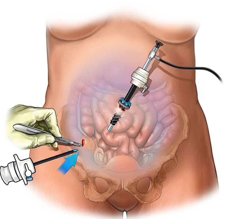 Laparoscopic surgery being performed by expert surgeons in Indore