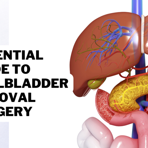 Essential Guide to Gallbladder Removal Surgery