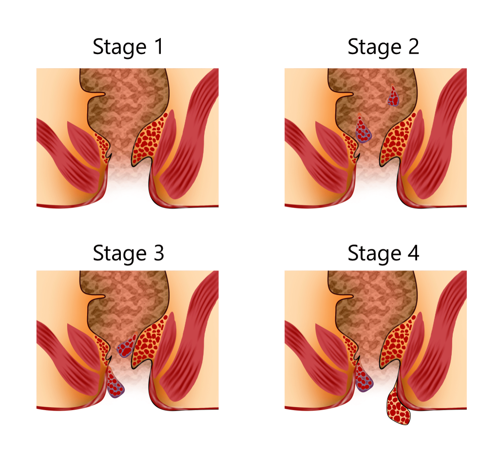 Effective piles treatment in Indore providing quick relief and recovery solutions