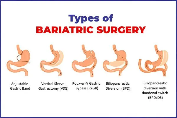 Top Bariatric Surgeon