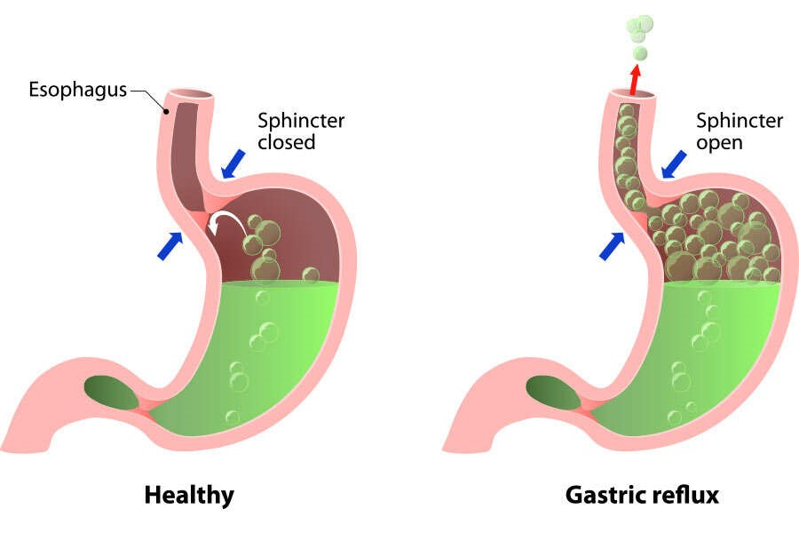 Effective Acid Reflux Treatment in Indore