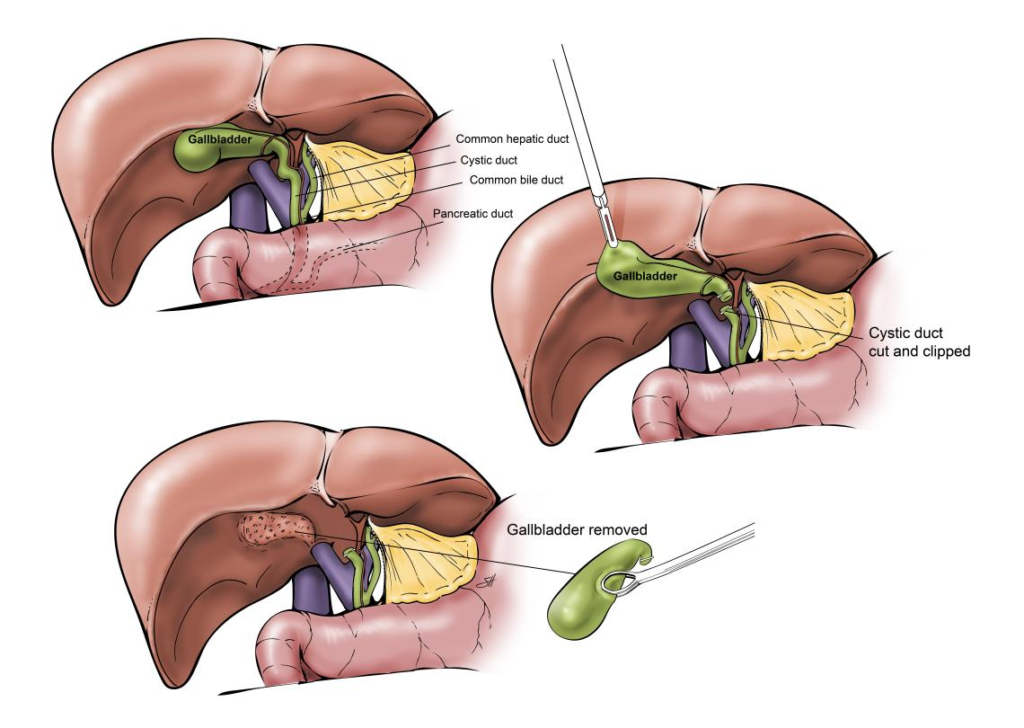 Gallbladder Removal Surgery