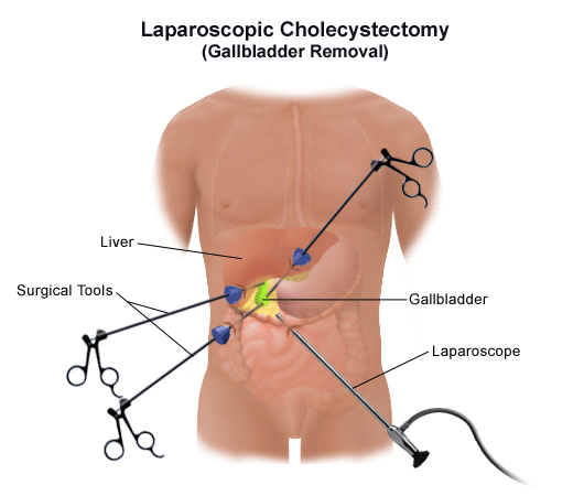 Gallbladder Removal Surgery