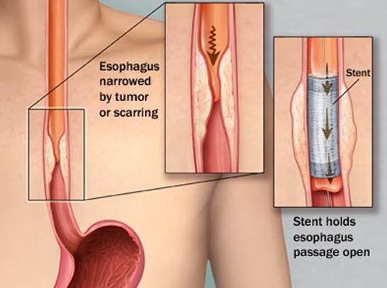 Expert Esophageal Surgery in Indore