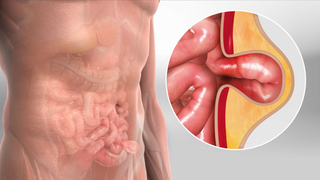 Top Hernia Specialist in Indore