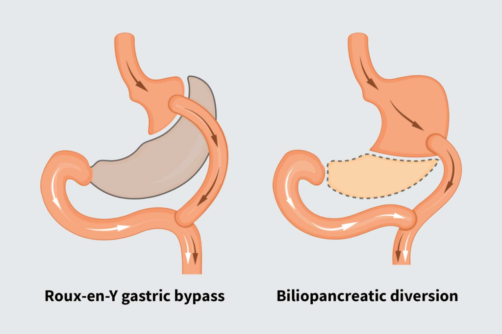 Top Bariatric Surgeon