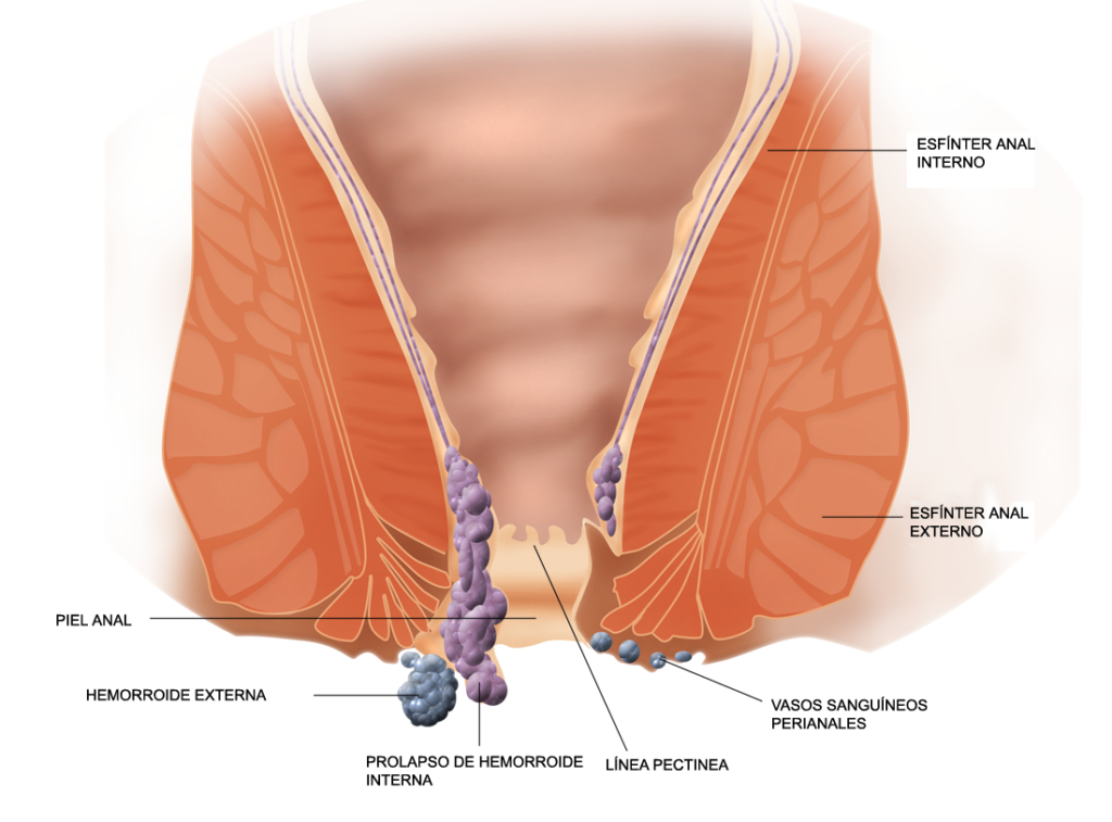 Effective piles treatment in Indore providing quick relief and recovery solutions