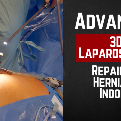 Advanced 3D Laparoscopic Repair of Hernia in Indore: The Future of Surgery