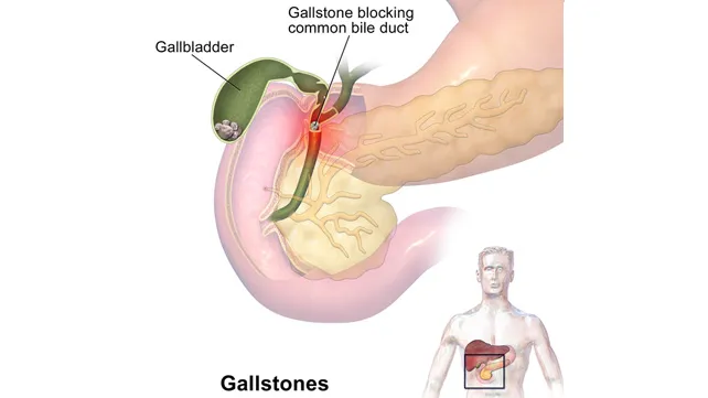 What are the Symptoms of Gallstones?