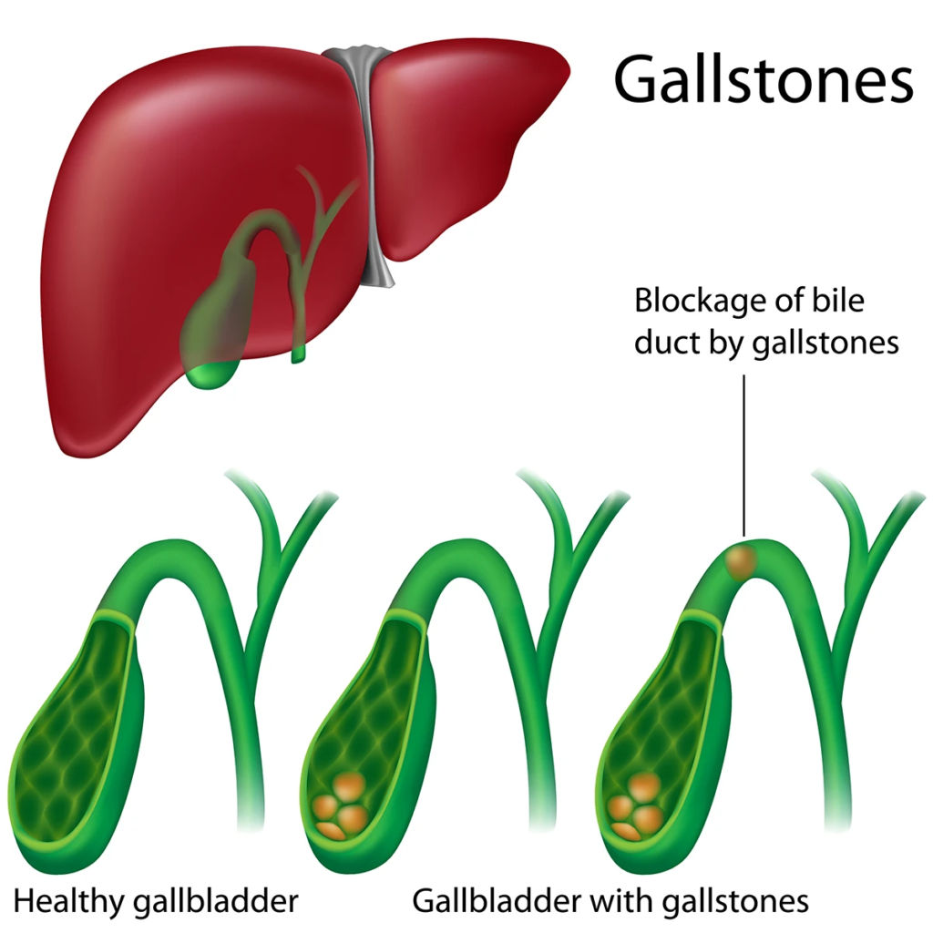 What are the Symptoms of Gallstones?