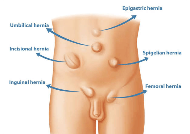 Top Laparoscopic Inguinal Hernia Repair Surgeons in Indore