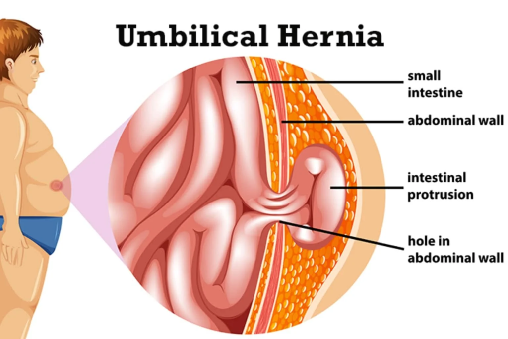 Top Laparoscopic Inguinal Hernia Repair Surgeons in Indore