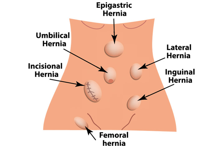 Top Laparoscopic Surgeons for Hernia Surgery in Indore: Expert Care