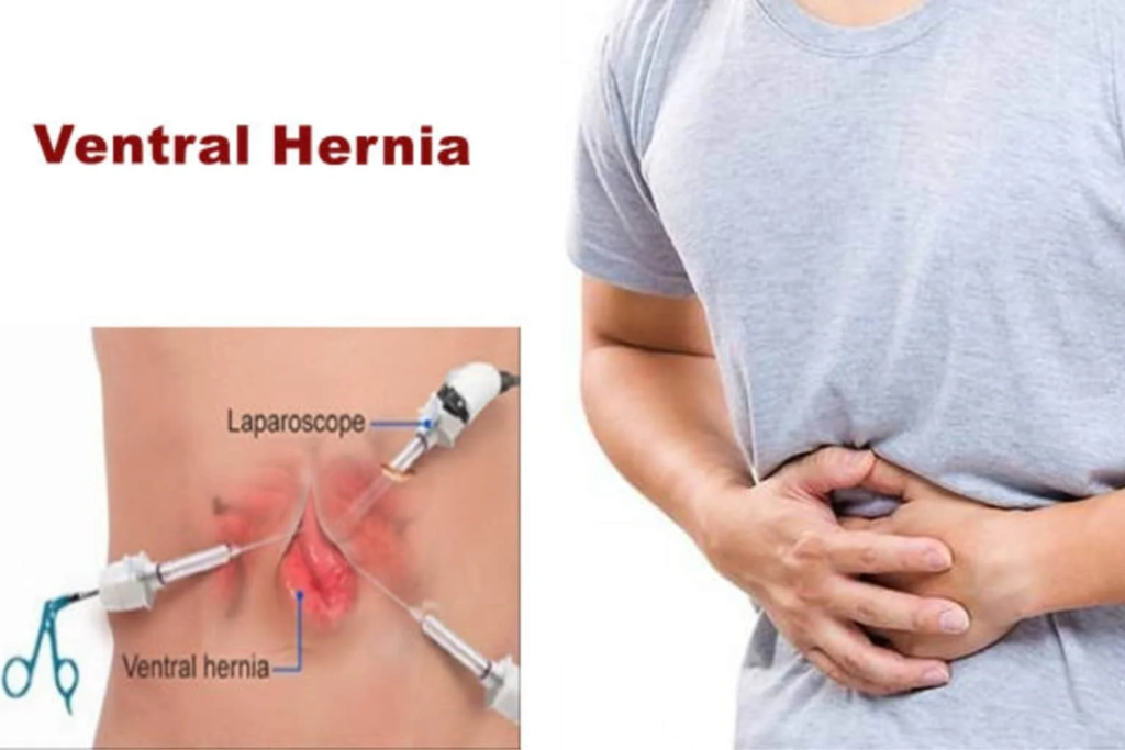 Best Laparoscopic Hernia Surgery Doctors in Indore: Get Treatment