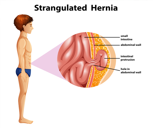 Understanding Hernia Hassles: Causes, Symptoms, and Treatments