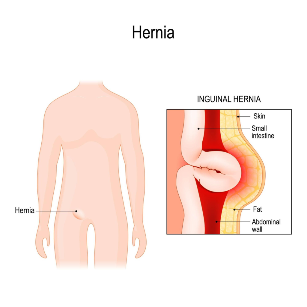 Understanding Hernia Hassles: Causes, Symptoms, and Treatments