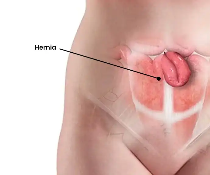 Understanding Hernia Hassles: Causes, Symptoms, and Treatments