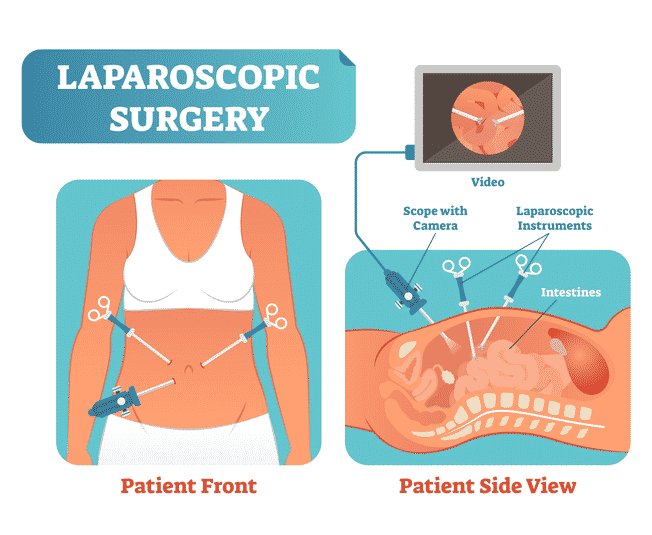 Best Clinics for Laparoscopic Surgery in Indore