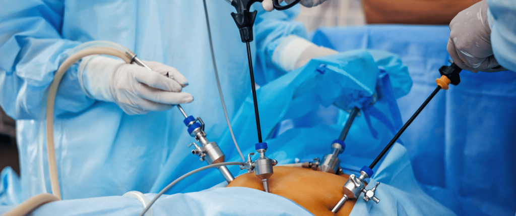 Quick and Smooth Recovery After Laparoscopic Surgery: Timeline and Tips