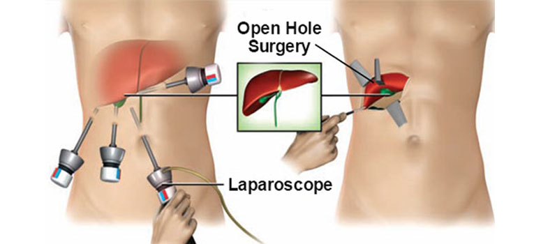 Comparing Laparoscopic and Open Surgery: Which is Better?