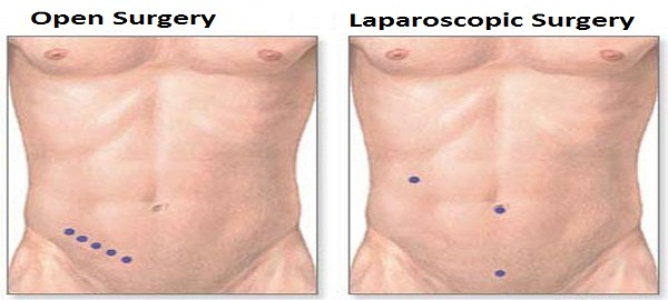 Comparing Laparoscopic and Open Surgery: Which is Better?