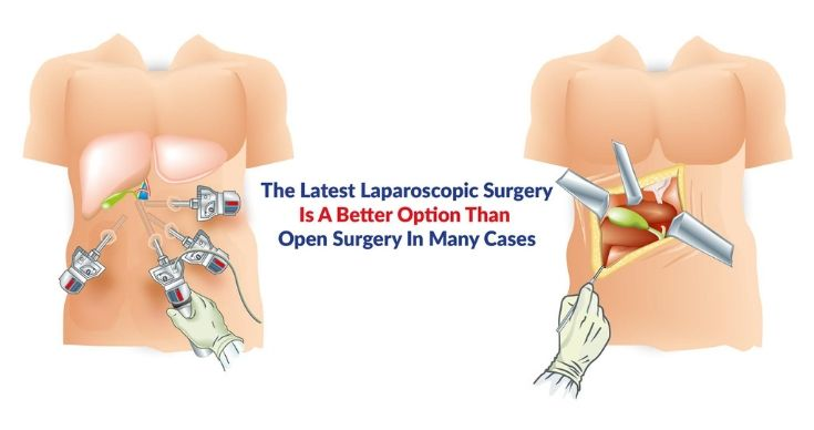 Comparing Laparoscopic and Open Surgery: Which is Better?