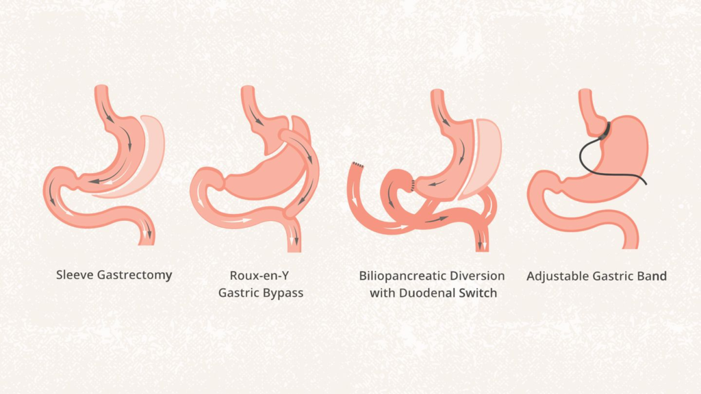 Bariatric Surgeon in Indore - Dr. Nikunj Jain 2 Bariatric Surgeon in Indore