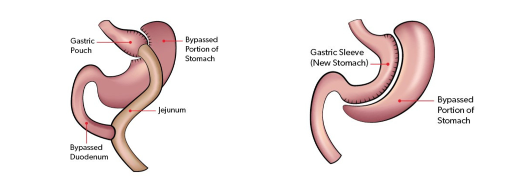 Bariatric Surgeon in Indore - Dr. Nikunj Jain 1 Bariatric Surgeon in Indore
