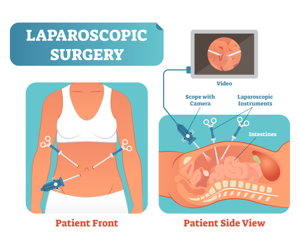 Laparoscopic Surgery in Indore