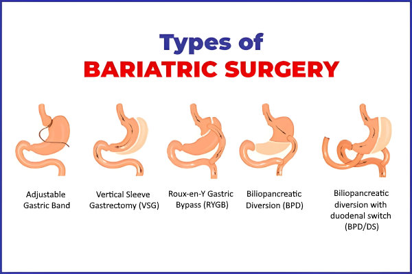 Bariatric Surgeon in Indore - Dr. Nikunj Jain 3 Bariatric Surgeon in Indore