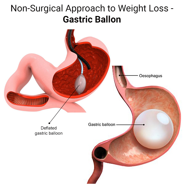 Top 5 Proven Non-Surgical Weight Loss Procedures in Indore by Dr. Nikunj Jain 1 Non-Surgical Weight Loss Procedures in Indore