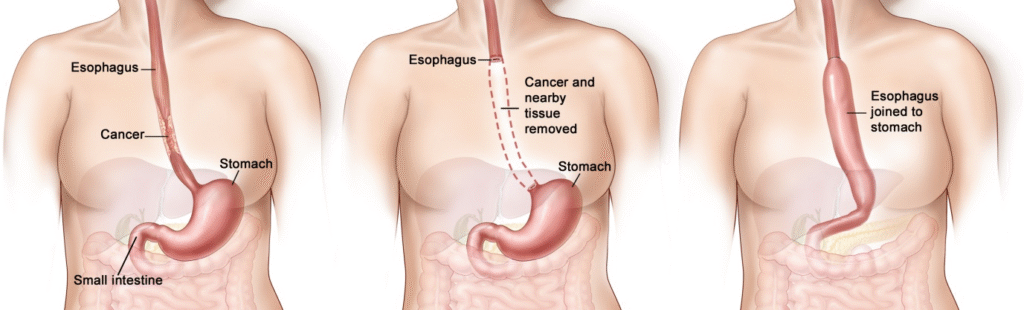 Esophageal Surgery in Indore | Dr. Nikunj Jain | Apollo Hospital 2 Esophageal Surgery in Indore