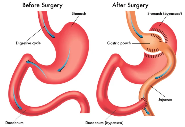 Bariatric Surgeon in Indore – Achieve Healthy Weight with Expert Surgery by Dr. Nikunj Jain 2 Bariatric Surgeon in Indore