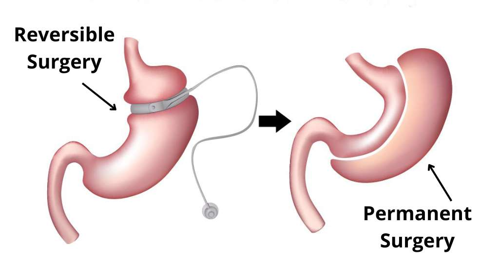 Bariatric Surgeon in Indore – Achieve Healthy Weight with Expert Surgery by Dr. Nikunj Jain 3 Bariatric Surgeon in Indore