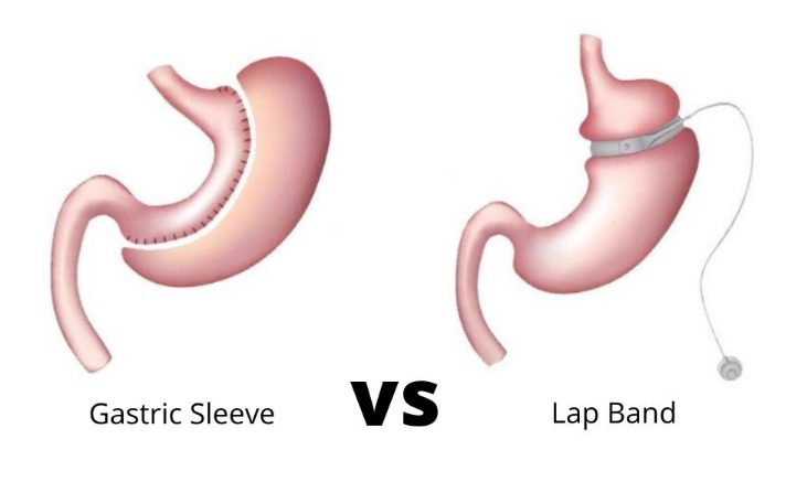 Bariatric Surgery Success Rates in Indore: A Comprehensive Guide by Dr. Nikunj Jain at Apollo Hospital 2 Bariatric Surgery Success Rates in Indore