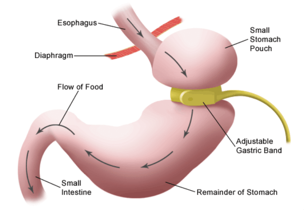 Bariatric Surgery Success Rates in Indore: A Comprehensive Guide by Dr. Nikunj Jain at Apollo Hospital 4 Bariatric Surgery Success Rates in Indore