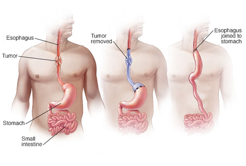 Esophageal Surgery in Indore | Dr. Nikunj Jain | Apollo Hospital 3 Esophageal Surgery in Indore